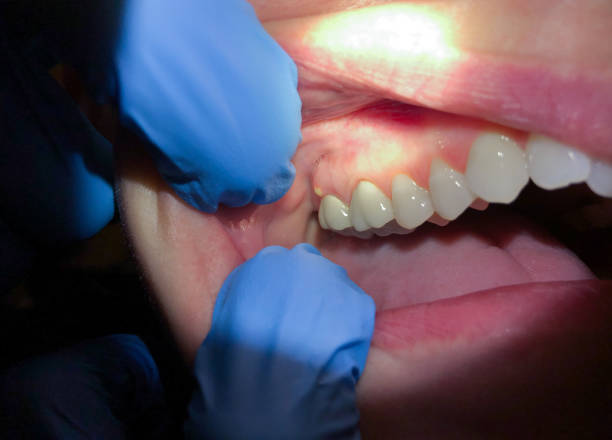 Best Knocked-Out Tooth Emergency  in Brookville, PA