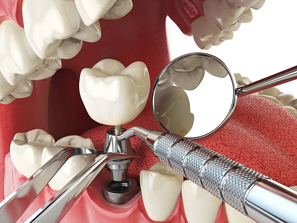Best Chipped Tooth Repair Near Me  in Brookville, PA